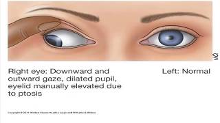 How to remember Cranial Nerves part 4 Abducens CNVI and Oculomotor nerve CNIII [upl. by Gnouhc206]