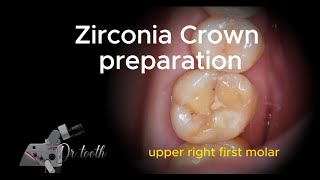 Zirconia crown preparation of upper first molar 상악 대구치 지르코니아 미러뷰 프렙 영상 [upl. by Diehl270]