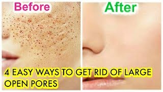 How To Treat Large Open Pores Naturally At Home Remedies SuperPrincessjo [upl. by Isabelita]