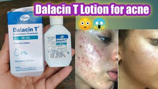 Dalacin T lotion for acne review  dalacin t Clindamycin phosphate lotion [upl. by Zeeba916]