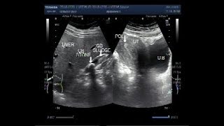 Ultrasound Video showing the difference between the Stone and Sludge in Gall Bladder [upl. by Pears482]