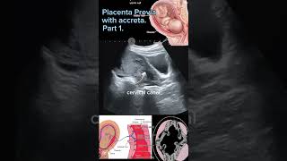 Understanding placenta accreta Medical insight Part1 shortsbeta ytshorts health DrSaimakhan [upl. by Desma]