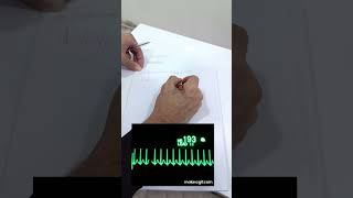 Common Cardiac Rhythm Kurdish  گرنگترین حاڵەتەکانی لێدانی دڵ بە کوردی [upl. by Saiasi214]