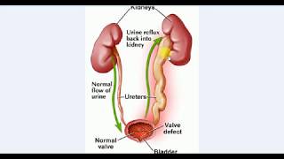 Pediatrics  Kidney  5  VESICOURETRIC REFLUX [upl. by Harak]