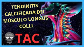 TENDINITIS Calcificada del Músculo LONGUS COLLI en TOMOGRAFÍA [upl. by Airegin]