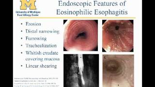 Eosinophilic Esophagitis Matthew Greenhawt MD [upl. by Artimid]