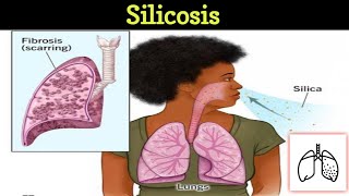 Pneumoconiosis 12  Silicosis [upl. by Redman]