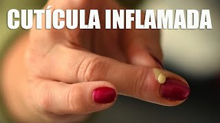 CUTÍCULA INFLAMADA  CAUSAS SINTOMAS E TRATAMENTO [upl. by Camala]