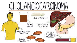 Understanding Cholangiocarcinoma [upl. by Uri]