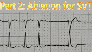 ABLATION for AVNRTSupraventricular Tachycardia SVT and moving on Part 2 [upl. by Inafets]