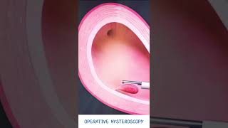 Operative Hysteroscopy  Fibroid amp Polyp removal  Hysteroscopic polypectomy  Types of Hysteroscope [upl. by Cirilo192]