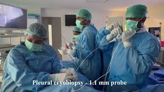 Mesothelioma  Thoracoscopic Pleural Cryobiopsy AMBU aScope5  11 mm Cryoprobe [upl. by Benedix]