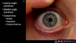 What is Conjunctival Chemosis [upl. by Beutner]