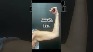 Extended arm lift Before and After  Austin Arm Lift [upl. by Rammus134]