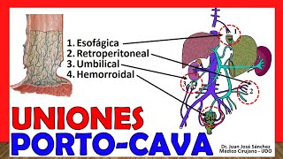 🥇 Uniones PORTOCAVA PORTOSISTÉMICAS Para entender la Hipertensión Portal [upl. by Inafets]