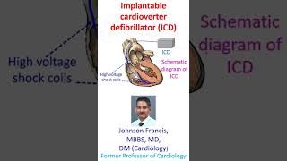 Implantable cardioverter defibrillator ICD [upl. by Sheffy]