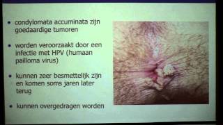 Anale condylomen  proctologie  Dr Tom Feryn [upl. by Melesa990]