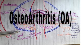 Osteoarthritis  Pathophysiology Clinical Features Diagnosis Management [upl. by Hartill633]