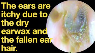 The ears are itchy due to the dry earwax and the fallen ear hairear wax removal  ASMR [upl. by Beaston]