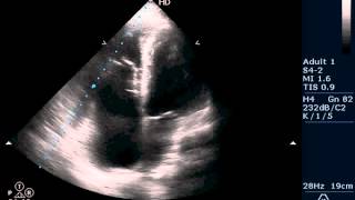 Ebsteins anomaly echocardiography series by Dr Sandeep kumar [upl. by Vivl]