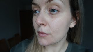 NEOSTRATA PROSYSTEM PEEL REVIEW [upl. by Leiva]