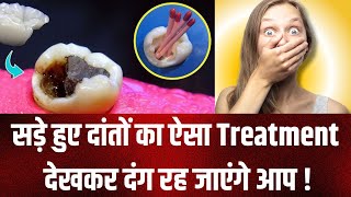 सड़े हुए दांतों का ऐसा ट्रीटमेंट देखकर दंग रह जाएंगे आप   Root Canal Treatment  Dr Gul  Noida [upl. by Kinemod]