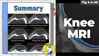 Fig 5A09 Summary of MRI Findings in Cartilage Damage [upl. by Anairdna]