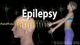 Epilepsy Types of seizures Symptoms Pathophysiology Causes and Treatments Animation [upl. by Severn]