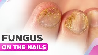 Fungus on the Nails  Koilonychia  Manicure and Fungus Cleanup [upl. by Marler]