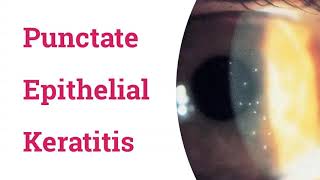 Punctate Epithelial Keratitis PEK [upl. by Ailla]