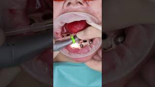 Dental implant’s All on 4 in Prague shorts dentist dental implant veneers short [upl. by Shulamith]