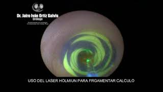 LITOTRICIA LASER EN CALCULO URETERA IZQUIERDO [upl. by Enavi219]