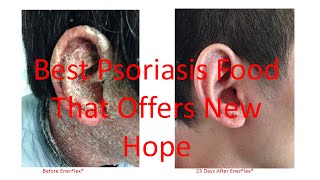 EnerFlex Nutrition  Case Studies on Scalp Plaque and Erythrodermic Psoriasis Updated 42016 [upl. by Ecaroh]