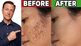 How to Get Rid of Hyperpigmentation Aging or Dark Spots [upl. by Annoel]