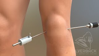 Knee Arthroscopy Animated Video [upl. by Alimak]