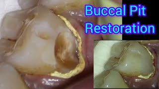 Deep Buccal Pit Restoration under Dental Operating Microscope  Composite Filling of Buccal Cavity [upl. by Files144]