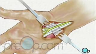 Carpal Tunnel Syndrome Surgery  PreOp Patient Education [upl. by Llennol]