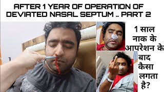 Deviated Septum Surgery  DNS  Septoplasty amp Turbinoplasty  Septoplasty Vlog In Hindi Part 2 [upl. by Llemrej]