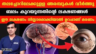 തലച്ചോറിലേക്കുള്ള ഞരമ്പുകൾ വീർത്തു ബലം കുറയുന്നതിന്റെ ലക്ഷണങ്ങൾ ഈ ലക്ഷണം നിസ്സാരമാക്കിയാൽ Dr Rinoy [upl. by Mcclary]