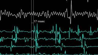 Reducing Noise Levels in Electrophysiology Medical Procedures [upl. by Haibot206]