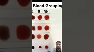 Blood Grouping kaise karte hain traning blood shorts doctor labtechnologist bloodgroup [upl. by Llibyc]