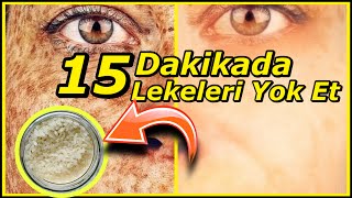 15 Dakikada CİLT LEKELERİ Sivilce ve AKNE İzleri Nasıl GeçerCilt BEYAZLATICI Pirinç Kremi [upl. by Edna]