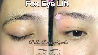 Fox Eye Lift  Brow Lift Full Procedure for only 7999php [upl. by Hazrit]