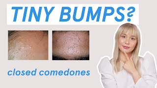 Why those tiny bumps AREN’T fungal acne [upl. by Essirahc762]