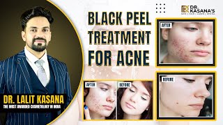 Black Peel Treatment for acne  Acne Treatment Facial Peel  Before and After Result [upl. by Pearlman27]