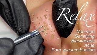 ☘️ Nặn mụn 🌸 Relax Satisfying Blackheads Acne Pore Vacuum Suction 27 [upl. by Gardal]