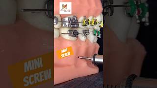 Mini Screw Dental Braces  Orthodontics [upl. by Basilius519]