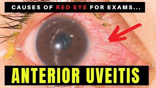 Causes of Red Eye  Part 2 ANTERIOR UVEITIS Iritis [upl. by Alberta]