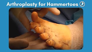 Arthroplasty Procedure for Hammertoes [upl. by Ethbinium]