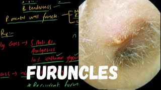 FURUNCLE  Localized Acute Otitis Externa [upl. by Enailuj626]